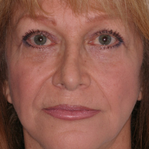 eyelid-lower-surgery-After25