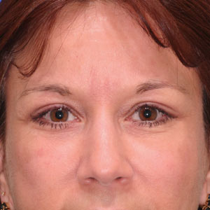 eyelid-lower-surgery-After27