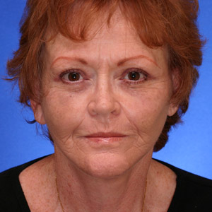 After lower facial rejuvenation
