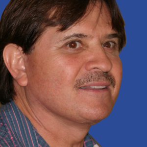After face lift surgery - male