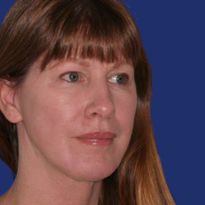 After chin implant - angle view