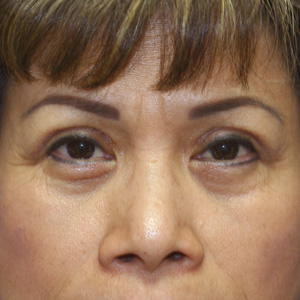 After upper eyelid correction - front view