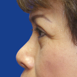 After upper eyelid correction - side view