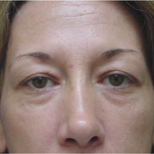 Before lower eyelid skin removal - front view