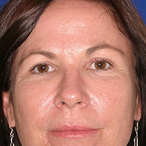 Before Facial Rejuvenation - front view