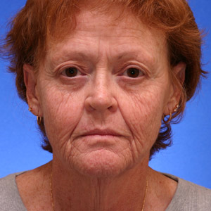 Before lower facial rejuvenation