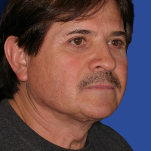 Before face lift surgery - male