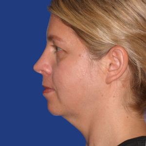 Before chin augmentation - side view