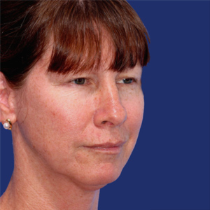 Before chin implant - angle view