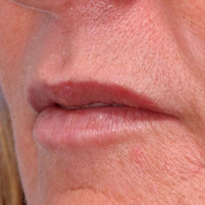 Before correction of thin lips