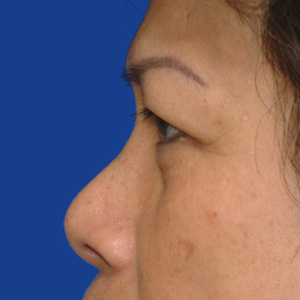 Before upper eyelid correction - side view