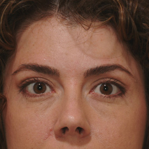 After browlift and upper skin removal - front view
