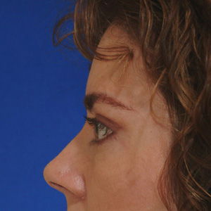 After brow lift and excess skin removal - side view