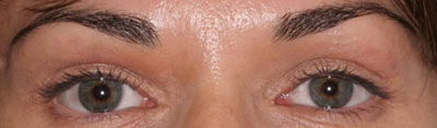 Hollow eyes after soft tissue filler - close