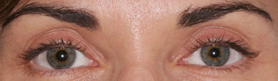 Hollow eyes before fat transfer - close