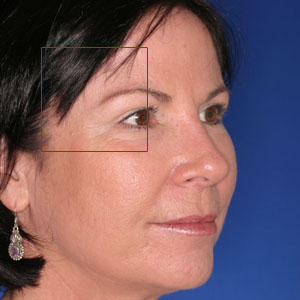 After facelift and eyelid surgery - woman