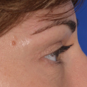 After soft tissue fillerupper eyelid - side view