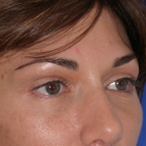 After soft tissue filler upper eyelid - angle view