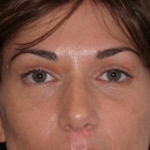 After soft tissue filler in upper eyelid - front view