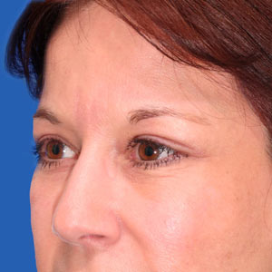 After Botox - eye area