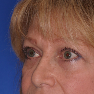 After lower eyelid skin removal - angle view