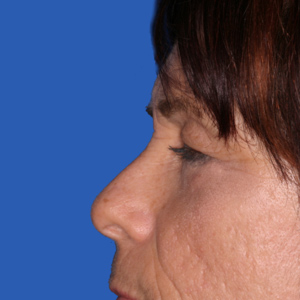 After removal of bags under the eyes - side view