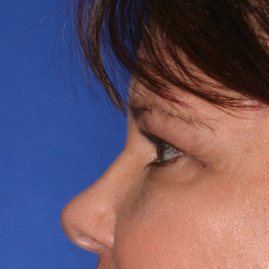 After correction of lower eye "bags" - side view