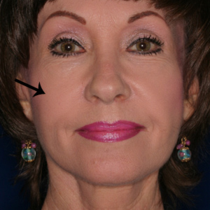 After fat transfer to the eye area - front view
