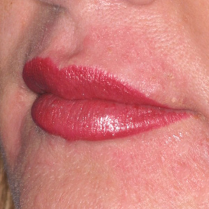 After correction of thin lips