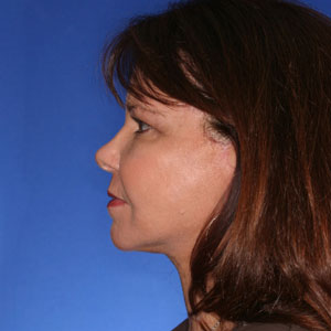 After neck lift - side view