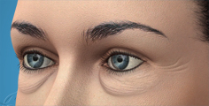 Animated removal of bags under the eyes