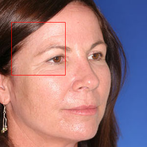 Before face lift and eyelid surgery - woman