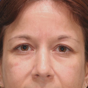 Before temple and brow lift - woman