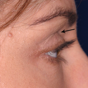 Before soft tissue filler in upper eyelid - side view