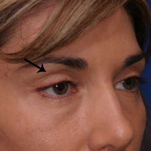 Before soft tissue filler in upper eyelid - angle view
