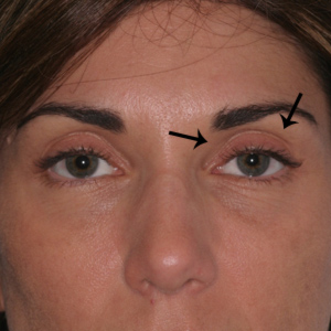 Before soft tissue filler in upper eyelid - front view
