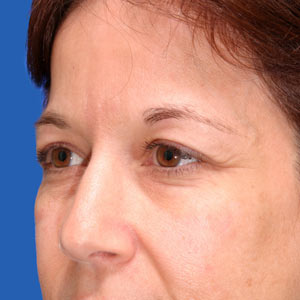Before Botox - eye area