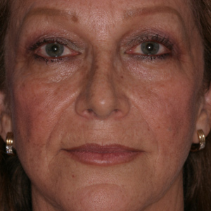 Before sun damage treatment - front view