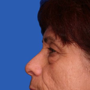 Before removal of bags under the eyes - side view