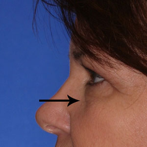 Before correction of lower eye "bags" - side view