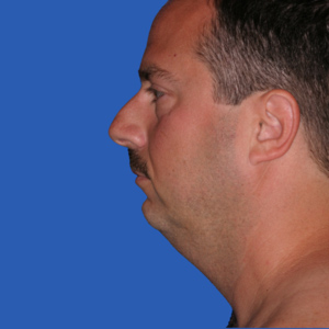 Before chin implant - male