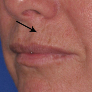 Upper lip wrinkles before chemical peel and dermabrasion