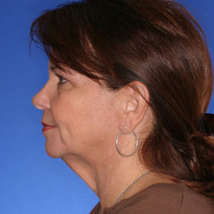 Before neck lift - side view