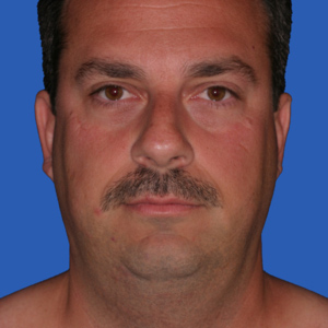 Before man's neck lift - front view