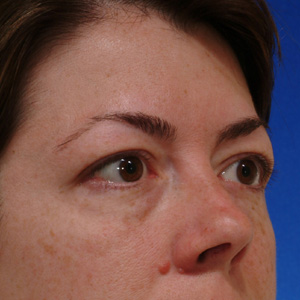 Before face lift, temple lift, and eyelid surgery