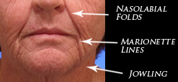 Problem areas of the lower face