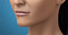 Animation of thin lips and upper lip wrinkles