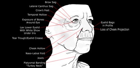 Diagram of an aging face