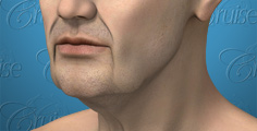Animated lower face correction - male