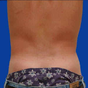 After liposuction on love handles - male